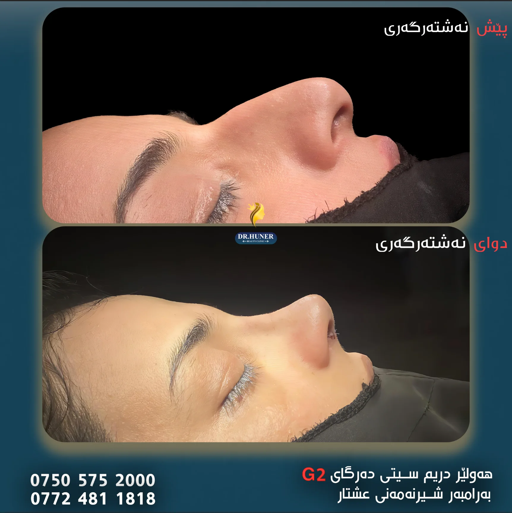 Rhinoplasty