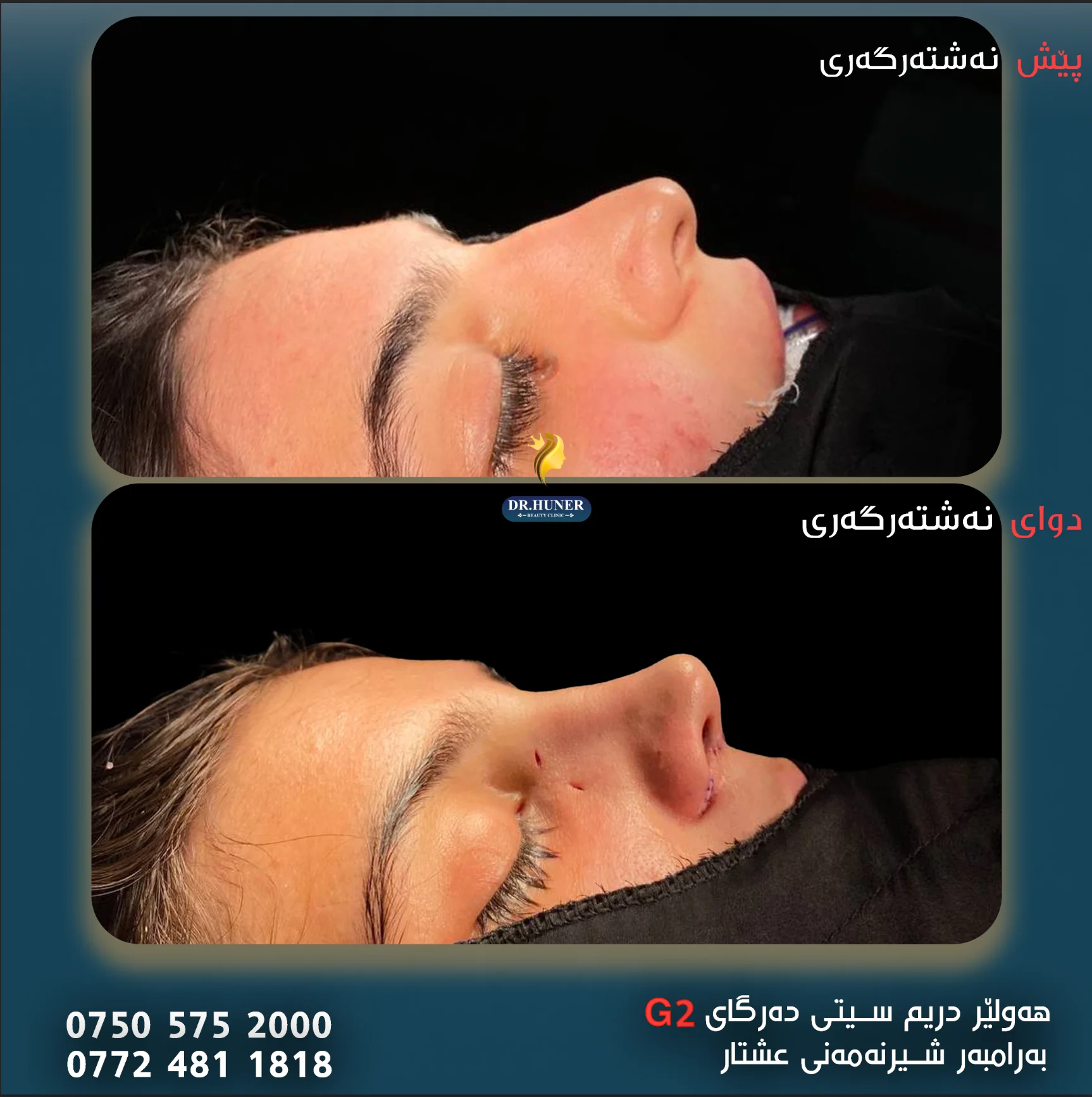 Rhinoplasty