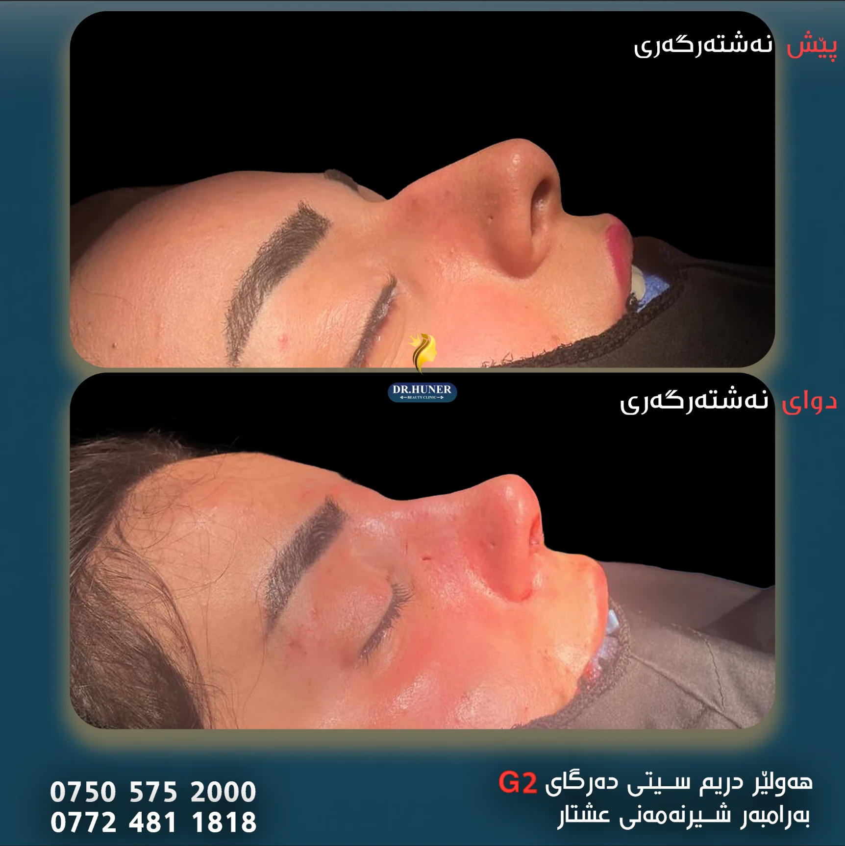 Laser Hair Removal